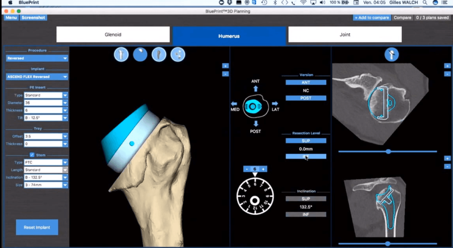 Mayo Clinic Performs First Shoulder Arthroplasty Procedure Using Mixed Reality