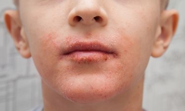 Boy with atopic dermatitis