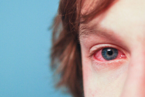 red eyes, allergies