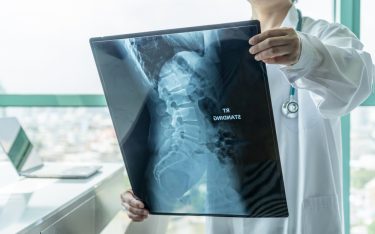 Doctor examining a scan of the human spine - idea of spinal disorder such as spinal muscular atrophy