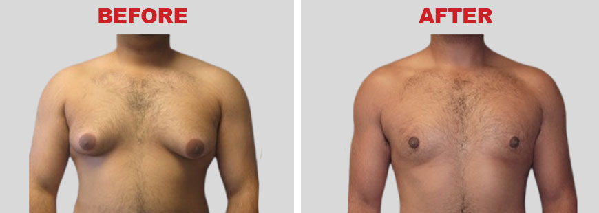 Male Breast Reduction Surgery Before and After