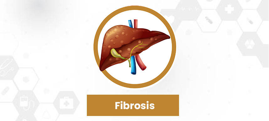 Stages of Liver Disease - Fibrosis